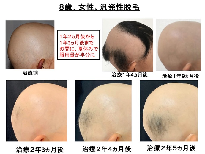 円形脱毛症　病院